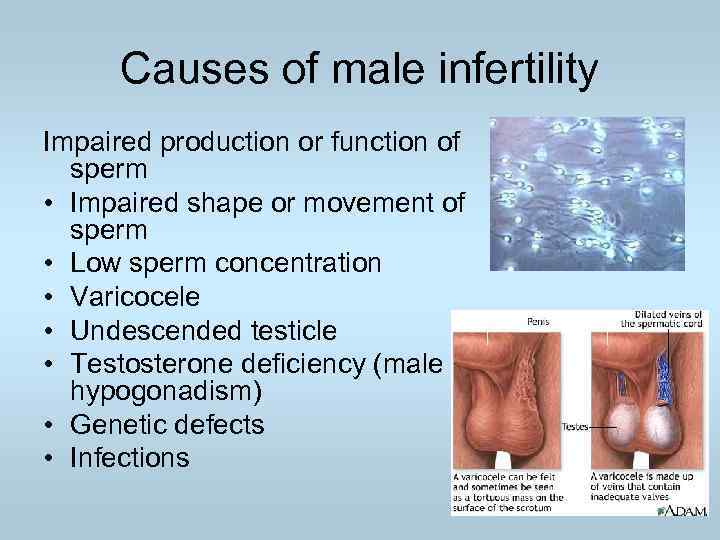 Causes of male infertility Impaired production or function of sperm • Impaired shape or