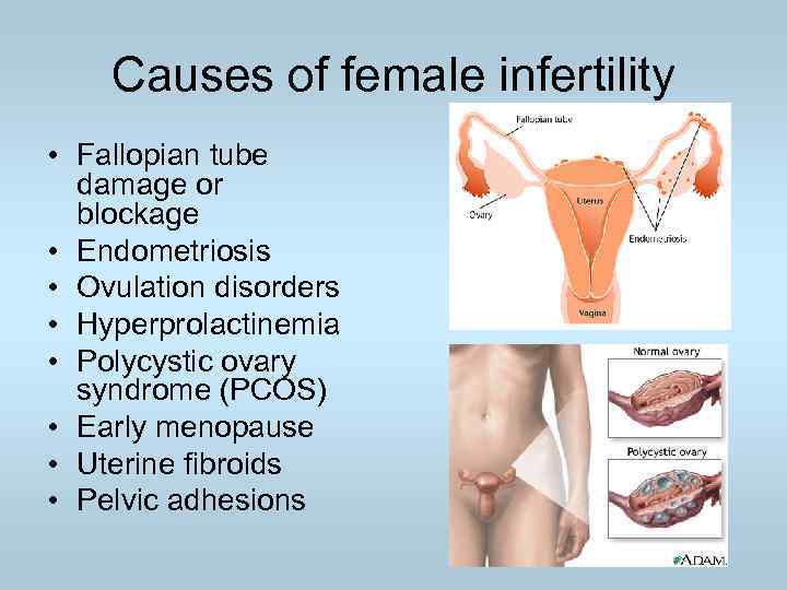 Causes of female infertility • Fallopian tube damage or blockage • Endometriosis • Ovulation