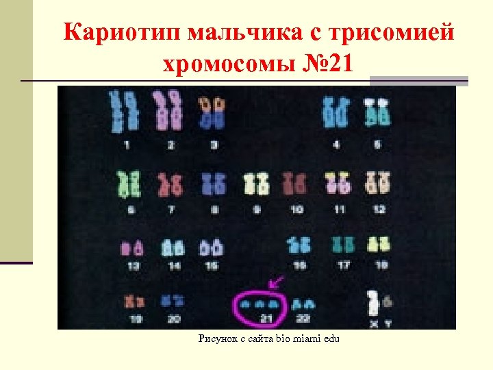 Кариотип мальчика с трисомией хромосомы № 21 Рисунок с сайта bio miami edu 