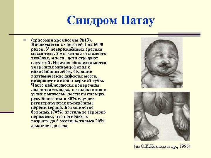 Синдром Патау n (трисомия хромосомы № 13). Наблюдается с частотой 1 на 6000 родов.