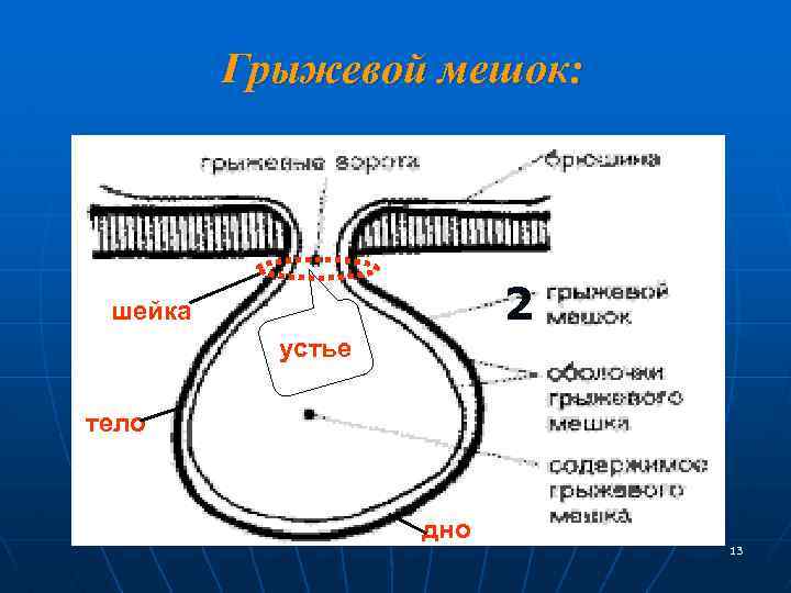 Грыжевой мешок: 2 шейка устье тело дно 13 