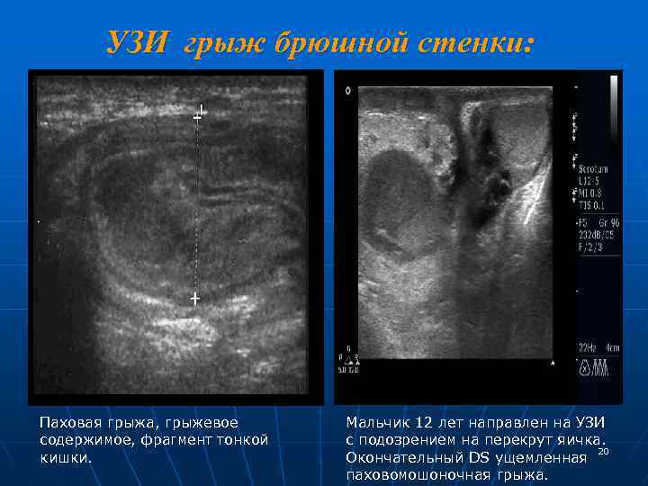 УЗИ грыж брюшной стенки: Паховая грыжа, грыжевое содержимое, фрагмент тонкой кишки. Мальчик 12 лет