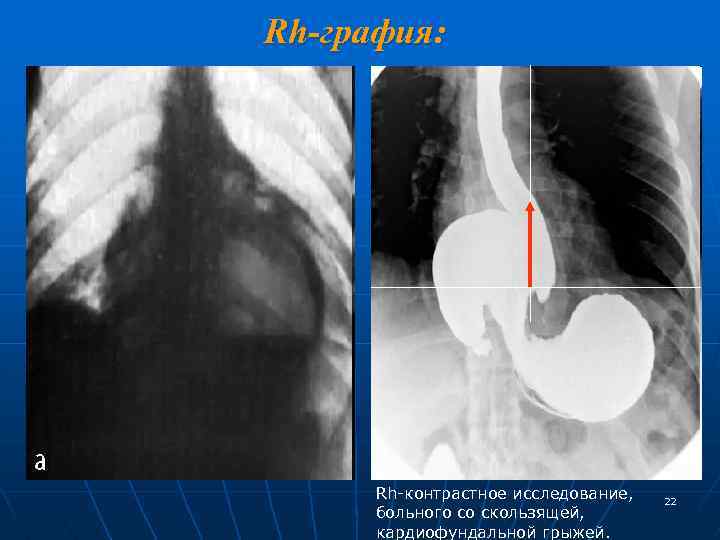 Rh-графия: Rh-контрастное исследование, больного со скользящей, кардиофундальной грыжей. 22 