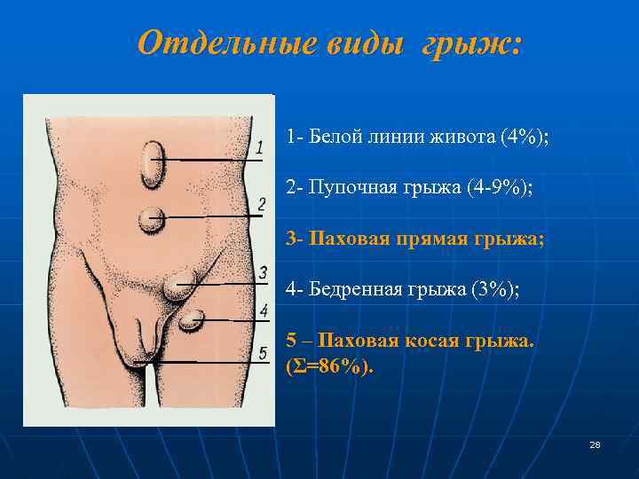 Отдельные виды грыж: 1 - Белой линии живота (4%); 2 - Пупочная грыжа (4