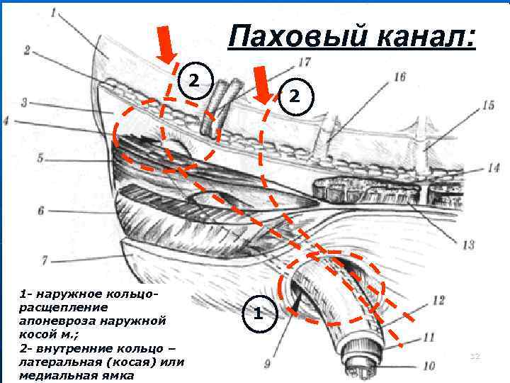 Паховый канал: 2 1 - наружное кольцорасщепление апоневроза наружной косой м. ; 2 -