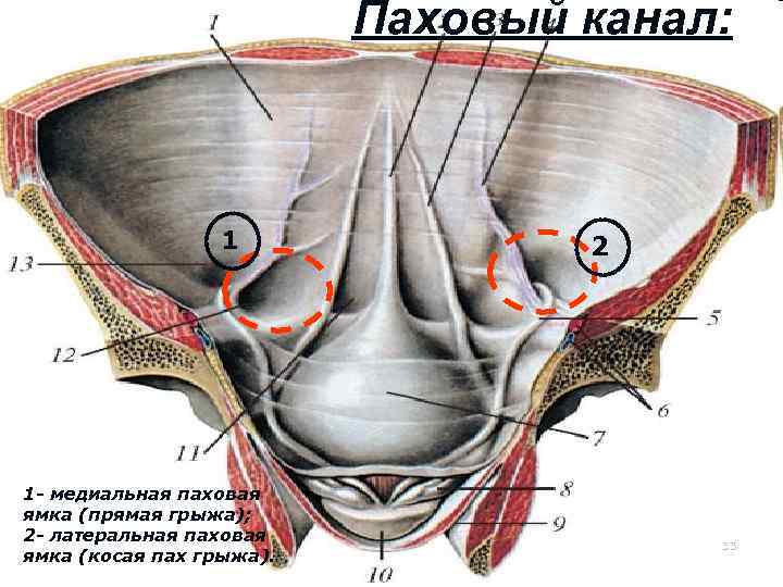 Паховый канал: 1 1 - медиальная паховая ямка (прямая грыжа); 2 - латеральная паховая