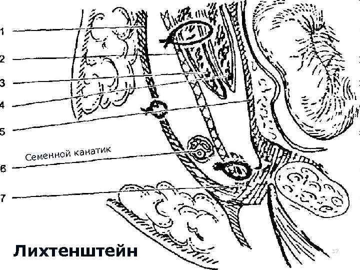 Непрерывнымпахового косой мышцы - подшивание Соединение внутренней промежутка и поперечной мышцы с Ликвидация швом