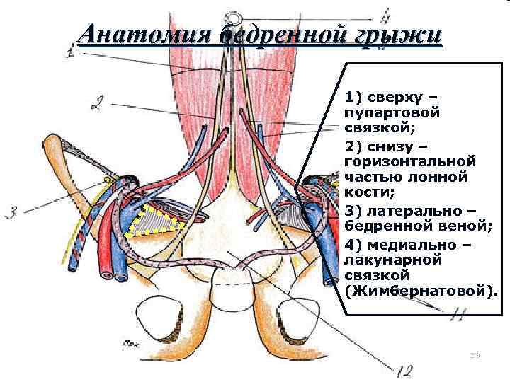 Анатомия бедренной грыжи 1) сверху – пупартовой связкой; 2) снизу – горизонтальной частью лонной