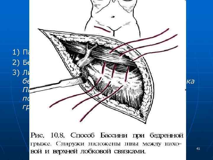 Основные виды пластики бедренной грыжи: 1) Паховый доступ (Руджи-Парлавеччио); 2) Бедренный доступ (Бассини); 3)