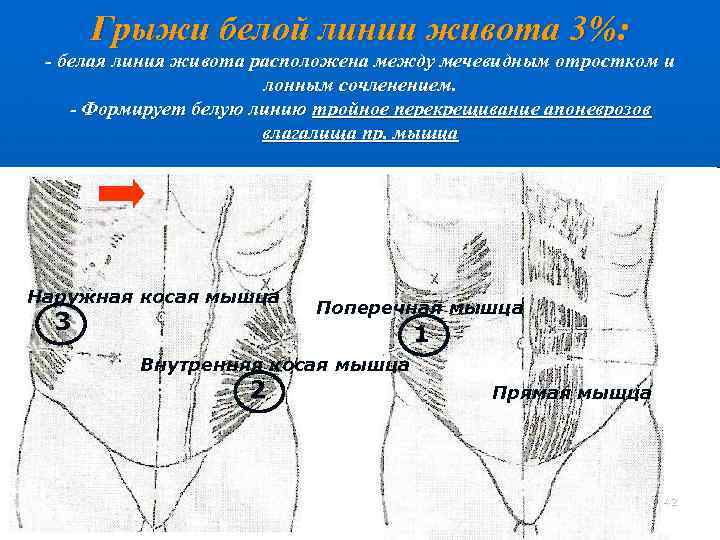 Грыжа белой линии живота лечение