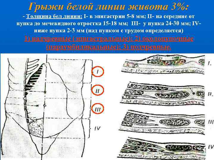 Грыжи белой линии живота 3%: - Толщина бел линии: I- в эпигастрии 5 -8