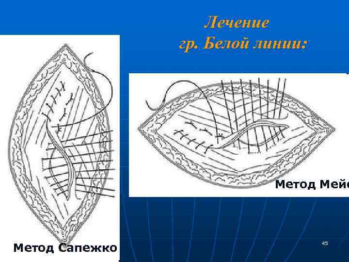 Лечение гр. Белой линии: Метод Мейо Метод Сапежко 45 