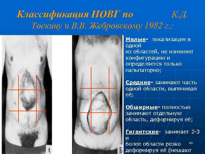 Классификация ПОВГ по К. Д. Тоскину и В. В. Жебровскому 1982 г. : Малые-