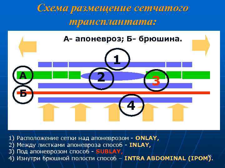 Схема размещение сетчатого трансплантата: А- апоневроз; Б- брюшина. 1 А Б 21 3 4