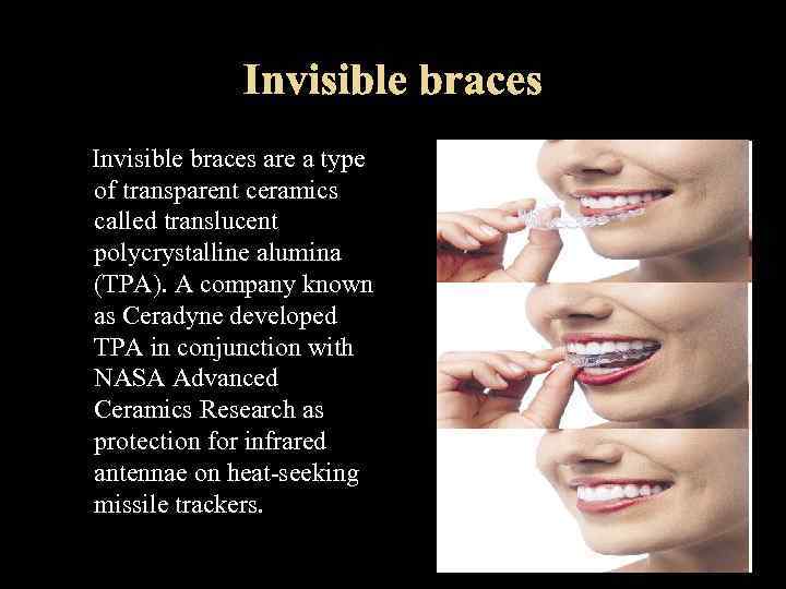 Invisible braces are a type of transparent ceramics called translucent polycrystalline alumina (TPA). A