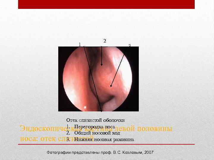 1 2 3 Отек слизистой оболочки 1. Перегородка носа Эндоскопическая картина левой половины 2.