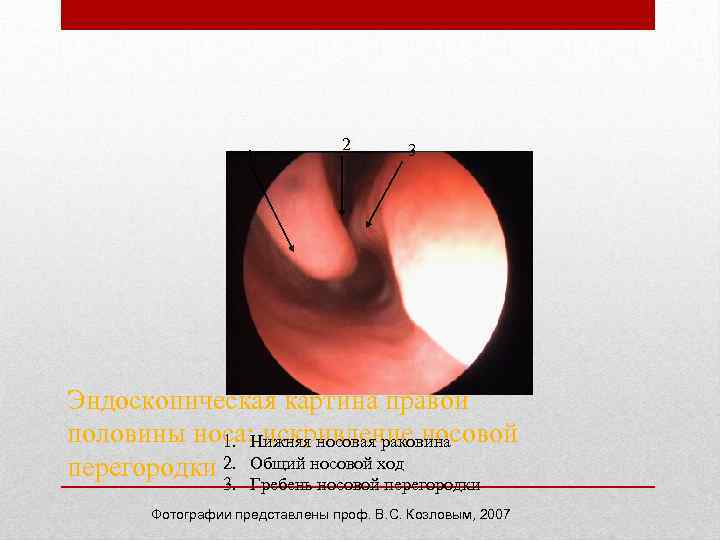 1 2 3 Эндоскопическая картина правой половины носа: искривление носовой 1. Нижняя носовая раковина