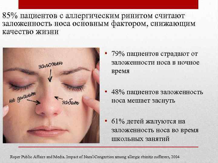 85% пациентов с аллергическим ринитом считают заложенность носа основным фактором, снижающим качество жизни •