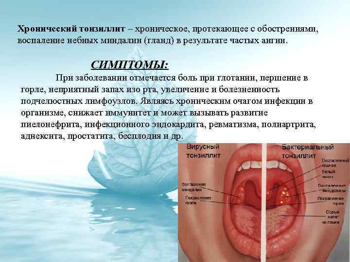 Хронический тонзиллит – хроническое, протекающее с обострениями, воспаление небных миндалин (гланд) в результате частых