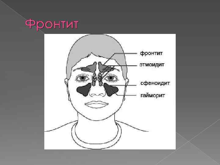 Фронтит симптомы