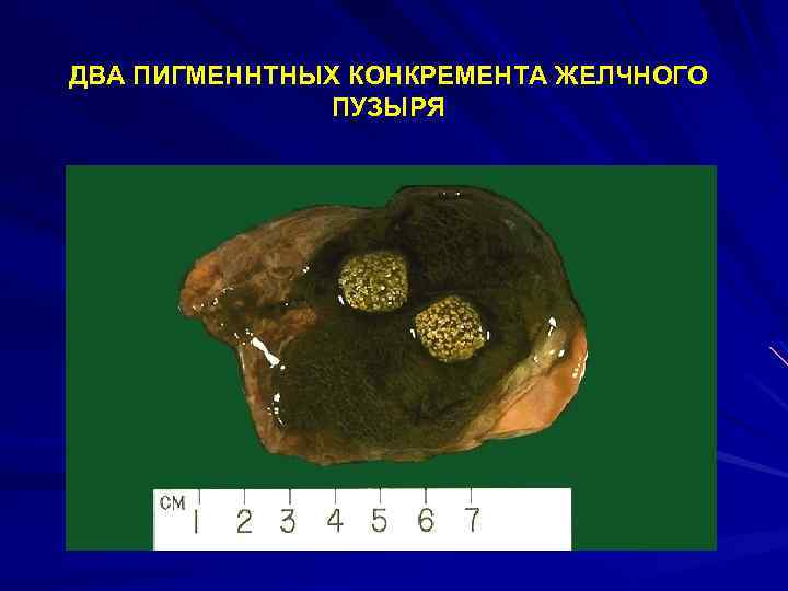 ДВА ПИГМЕННТНЫХ КОНКРЕМЕНТА ЖЕЛЧНОГО ПУЗЫРЯ 