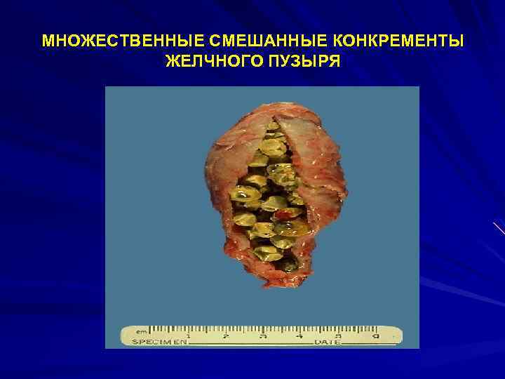 МНОЖЕСТВЕННЫЕ СМЕШАННЫЕ КОНКРЕМЕНТЫ ЖЕЛЧНОГО ПУЗЫРЯ 