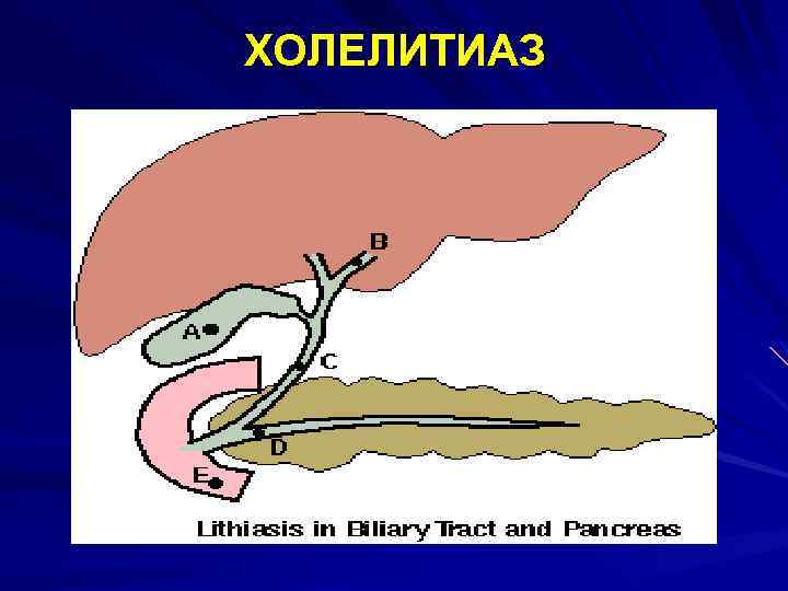 ХОЛЕЛИТИАЗ 