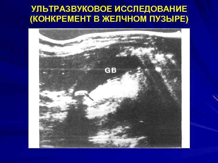 УЛЬТРАЗВУКОВОЕ ИССЛЕДОВАНИЕ (КОНКРЕМЕНТ В ЖЕЛЧНОМ ПУЗЫРЕ) 