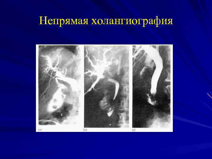 Непрямая холангиография 