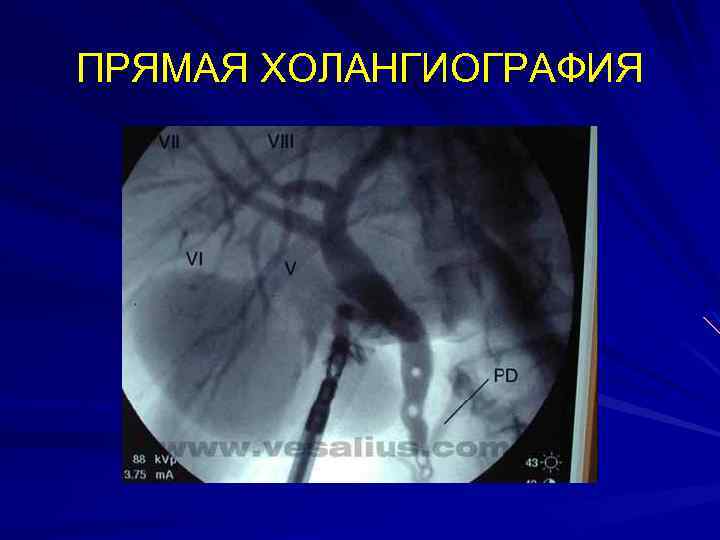 ПРЯМАЯ ХОЛАНГИОГРАФИЯ 