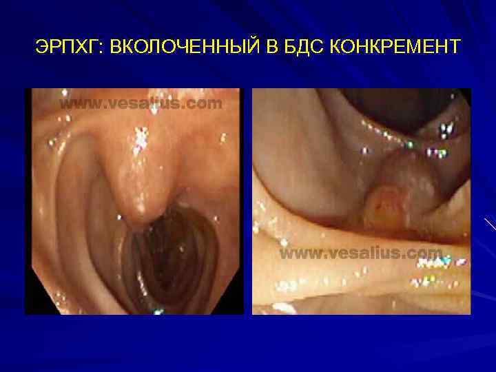 ЭРПХГ: ВКОЛОЧЕННЫЙ В БДС КОНКРЕМЕНТ 