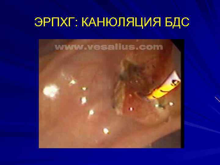 ЭРПХГ: КАНЮЛЯЦИЯ БДС 