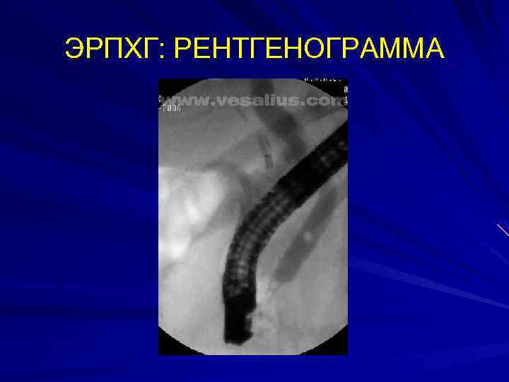 ЭРПХГ: РЕНТГЕНОГРАММА 