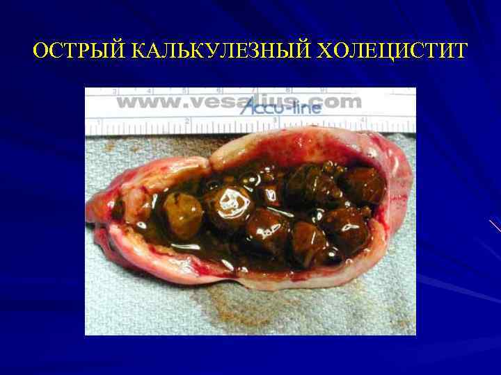 ОСТРЫЙ КАЛЬКУЛЕЗНЫЙ ХОЛЕЦИСТИТ 