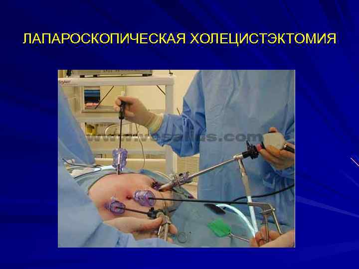 ЛАПАРОСКОПИЧЕСКАЯ ХОЛЕЦИСТЭКТОМИЯ 