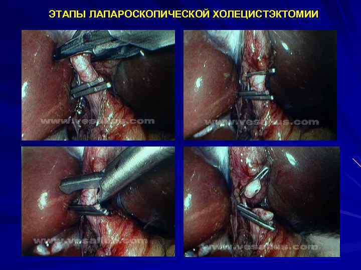  ЭТАПЫ ЛАПАРОСКОПИЧЕСКОЙ ХОЛЕЦИСТЭКТОМИИ 