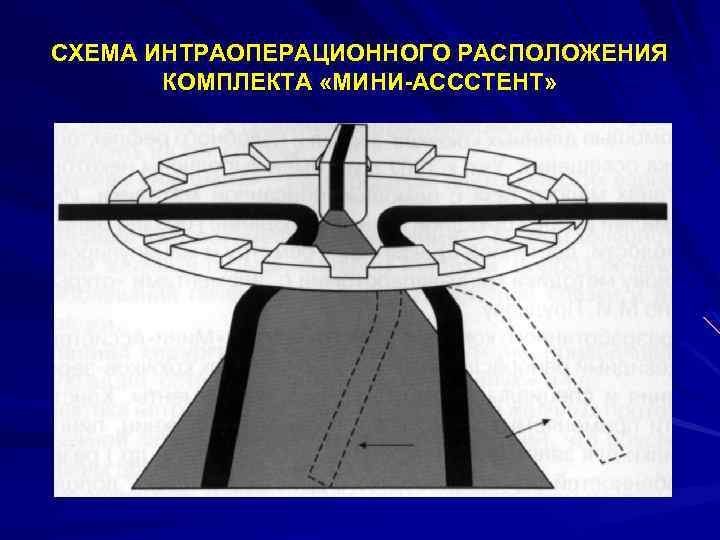 СХЕМА ИНТРАОПЕРАЦИОННОГО РАСПОЛОЖЕНИЯ КОМПЛЕКТА «МИНИ-АСССТЕНТ» 