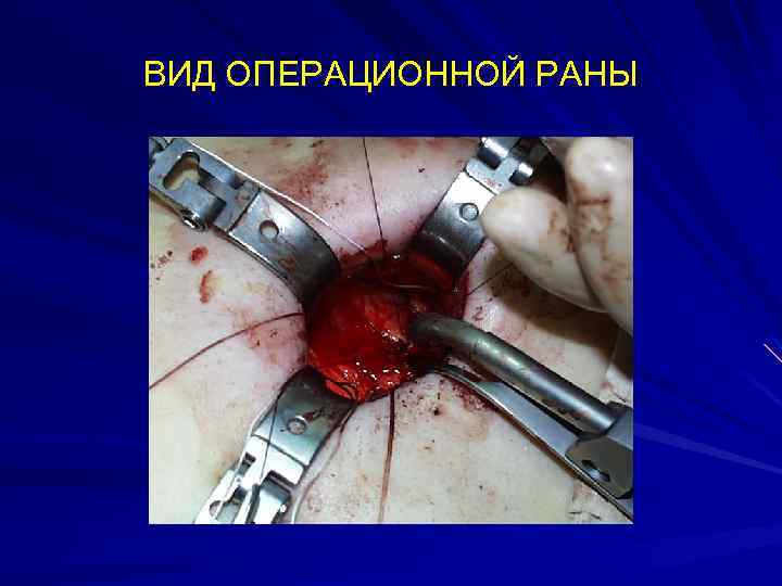 ВИД ОПЕРАЦИОННОЙ РАНЫ 