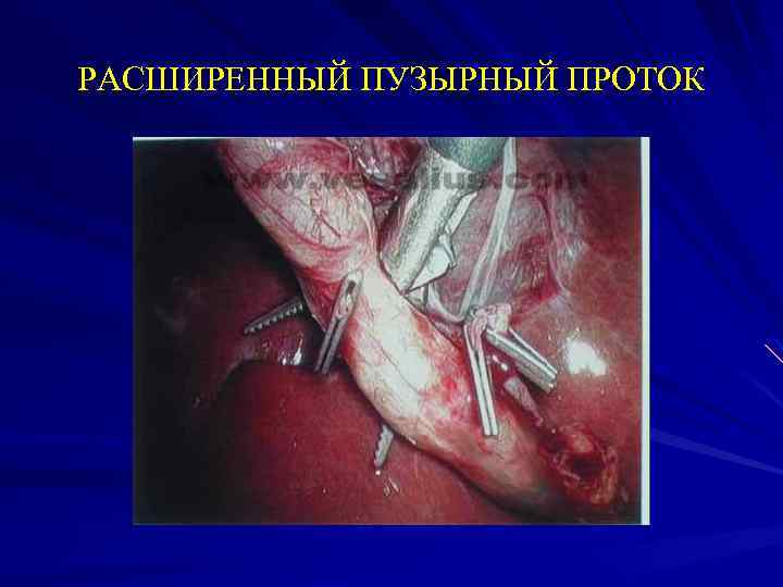 РАСШИРЕННЫЙ ПУЗЫРНЫЙ ПРОТОК 