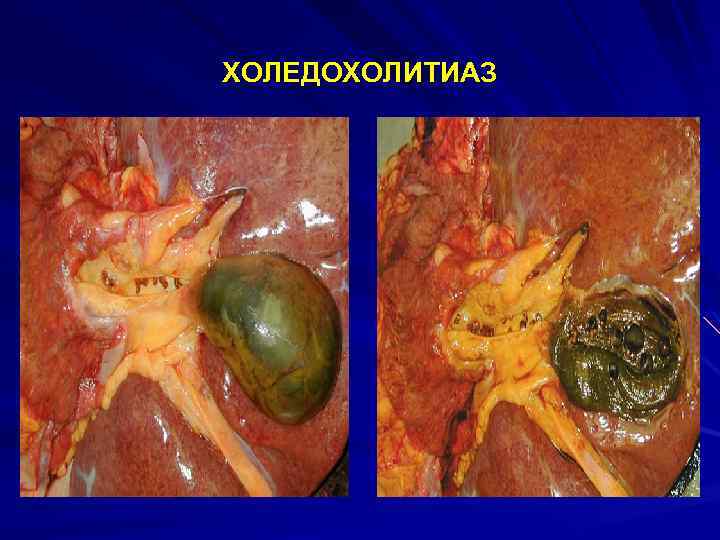 ХОЛЕДОХОЛИТИАЗ 