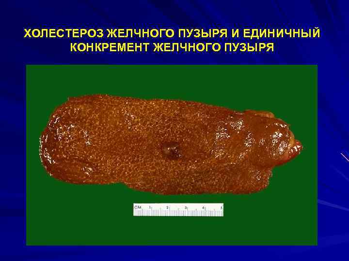 ХОЛЕСТЕРОЗ ЖЕЛЧНОГО ПУЗЫРЯ И ЕДИНИЧНЫЙ КОНКРЕМЕНТ ЖЕЛЧНОГО ПУЗЫРЯ 