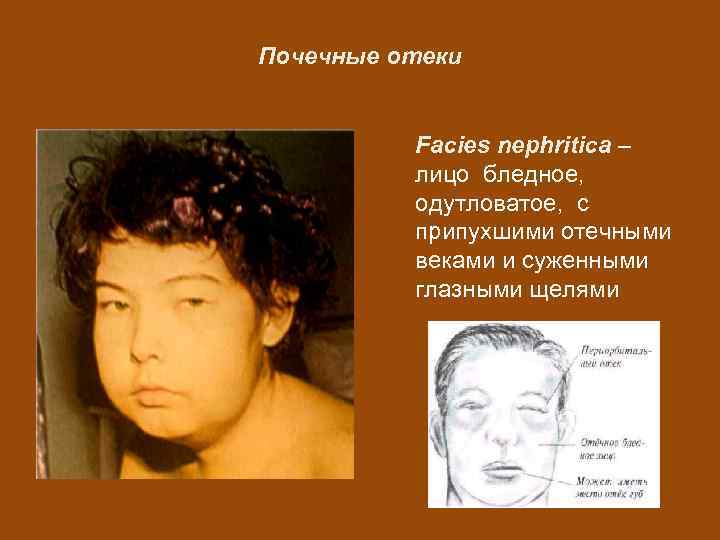 Почечные отеки Facies nephritica – лицо бледное, одутловатое, с припухшими отечными веками и суженными