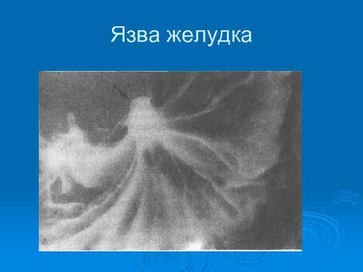 Язва желудка 