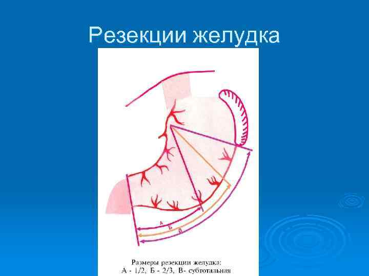 Резекции желудка 