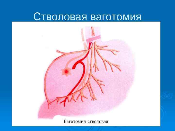 Стволовая ваготомия 