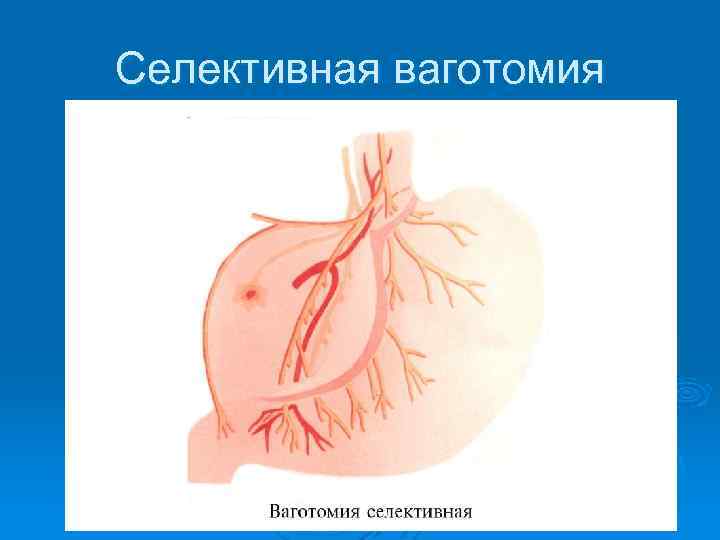 Селективная ваготомия 