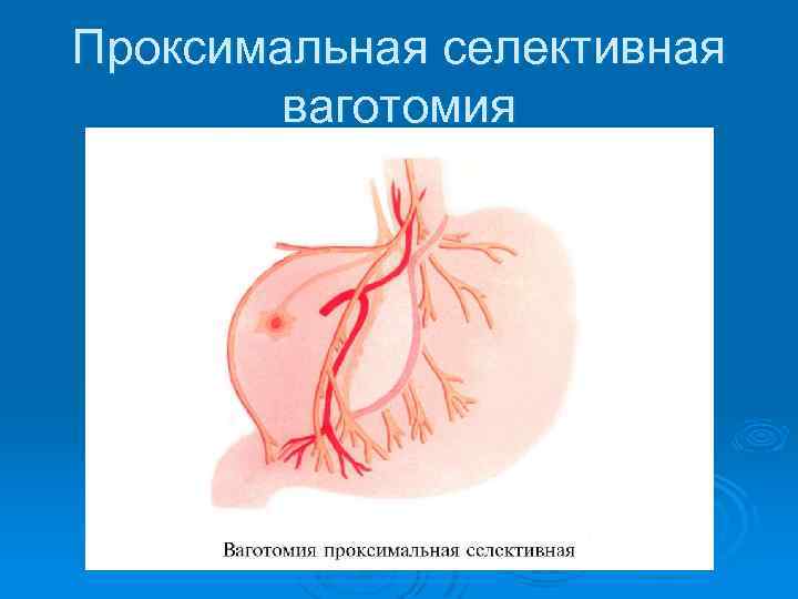 Проксимальная селективная ваготомия 