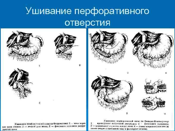 Ушивание перфоративного отверстия 