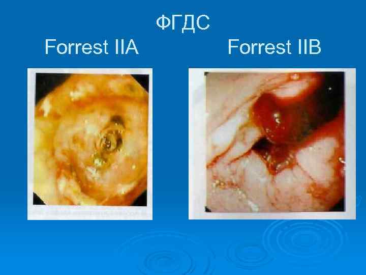 ФГДС Forrest IIA Forrest IIB 