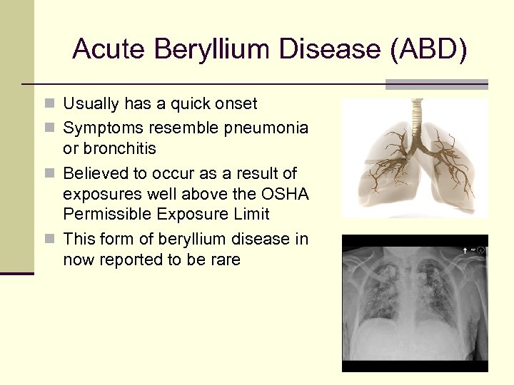 Acute Beryllium Disease (ABD) n Usually has a quick onset n Symptoms resemble pneumonia